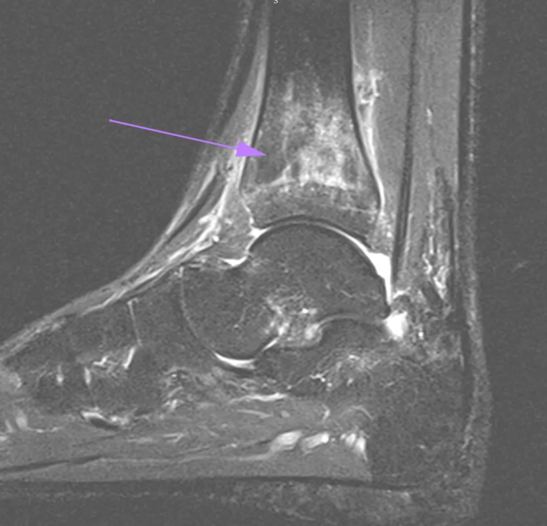 Magnetoterapia para edema óseo