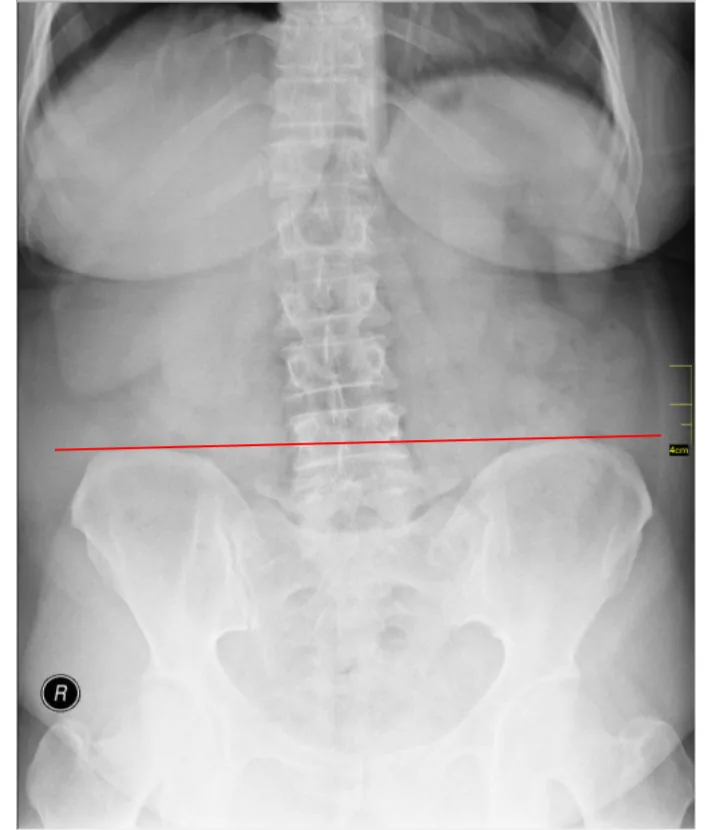 Magnetoterapia para el dolor lumbar crónico