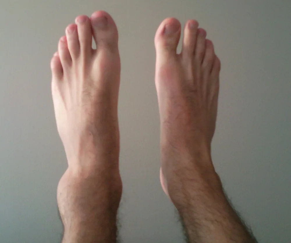 Magnetoterapia para edema por esguince de tobillo