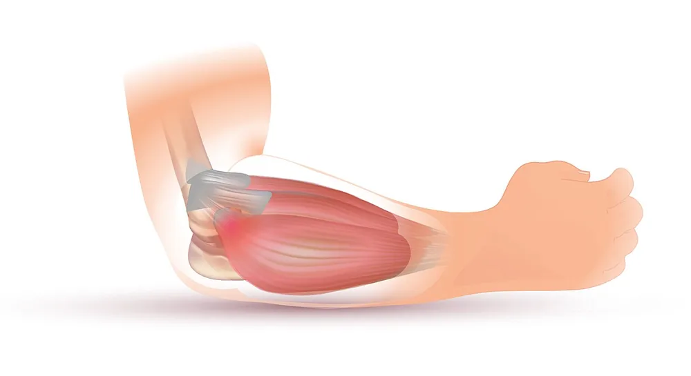 Magnetoterapia para la epicondilalgia (codo de tenista)