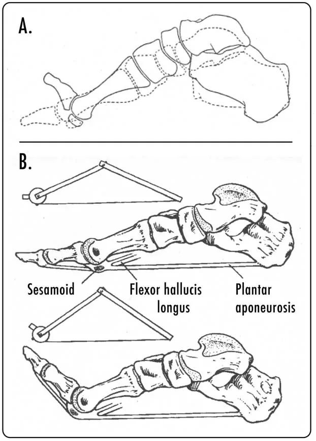 Magnetoterapia para la fascitis plantar y el espolón calcáneo