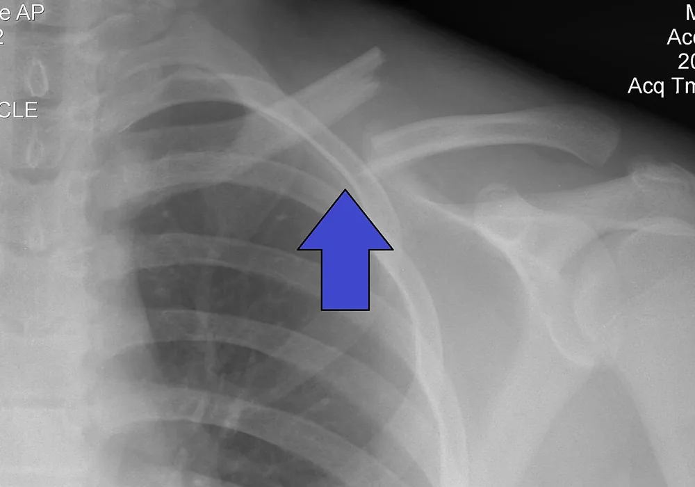 Magnetoterapia para fractura de clavícula
