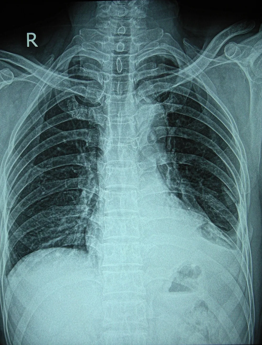 Magnetoterapia para fractura de costillas