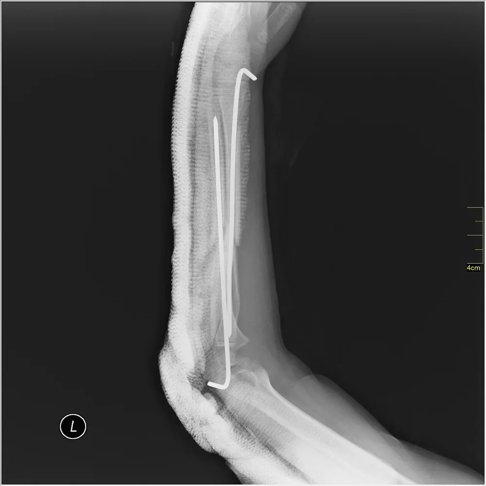 Magnetoterapia para fractura de cúbito