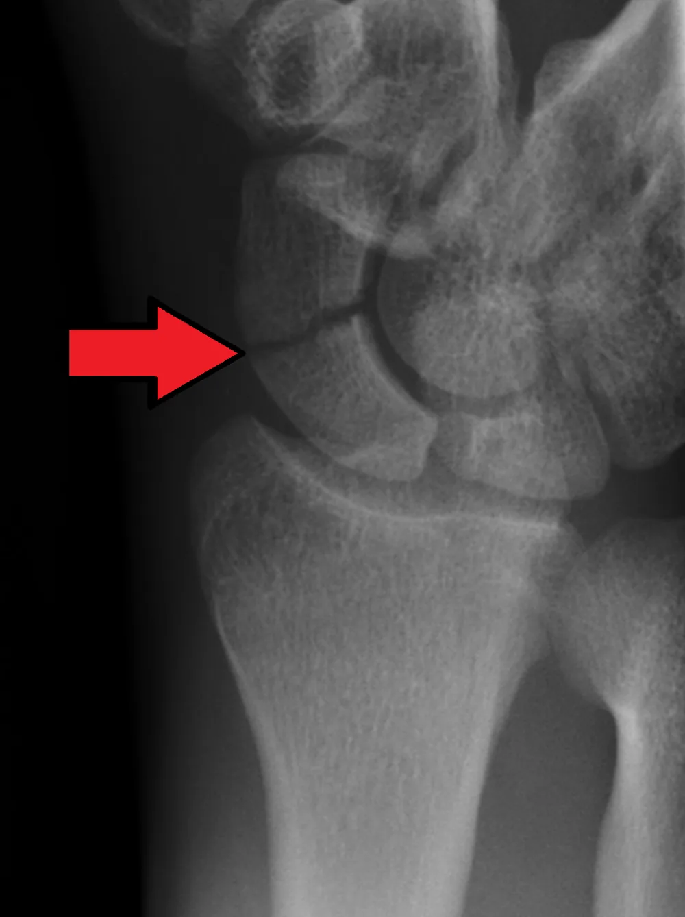 Magnetoterapia para fractura de escafoides