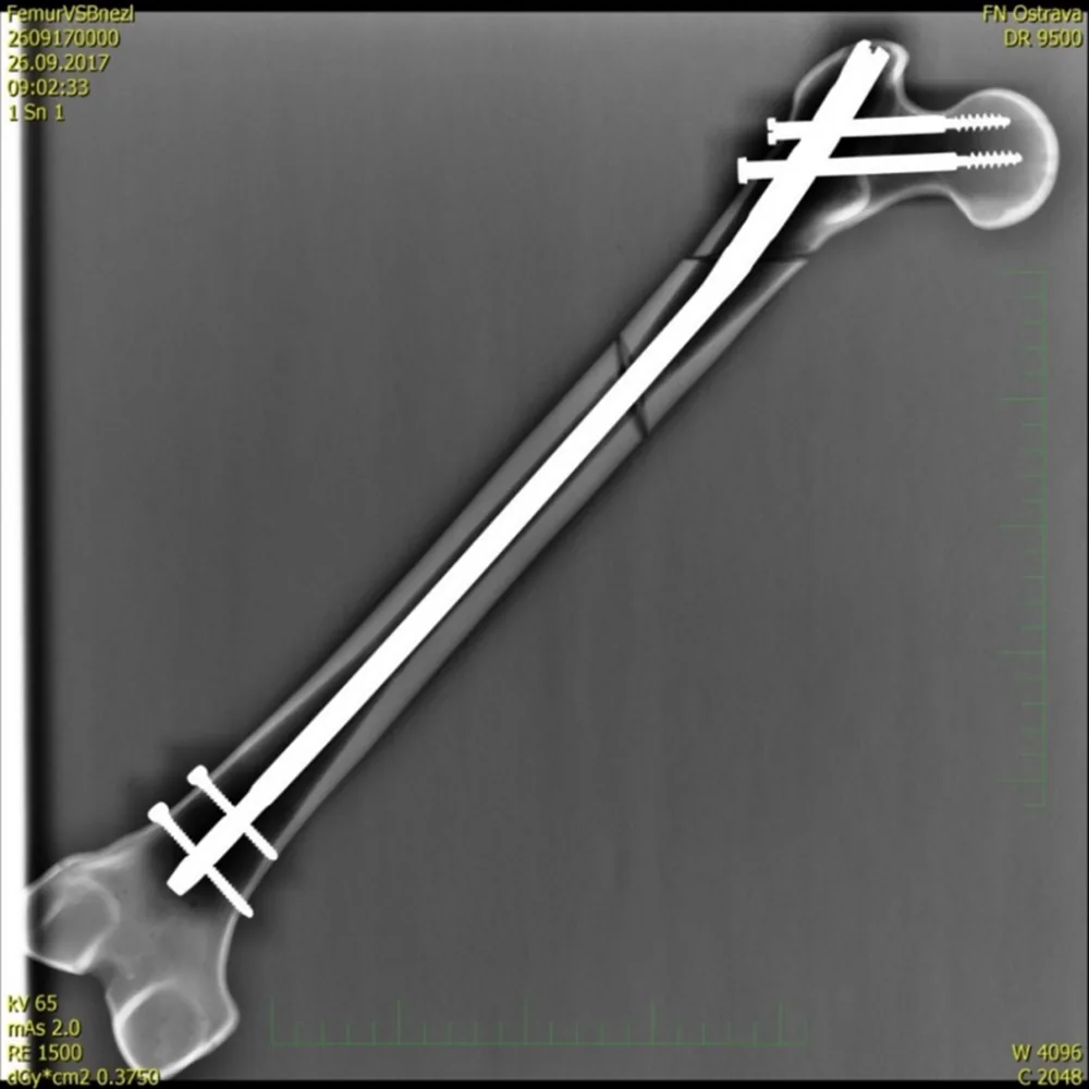 Magnetoterapia para fracturas (guía general)
