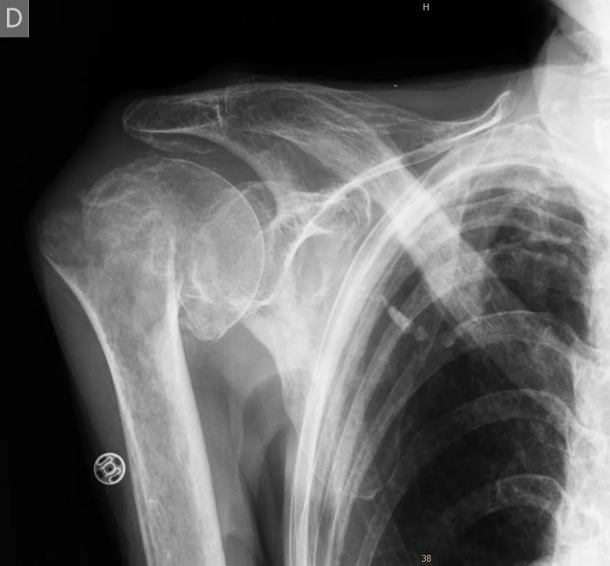 Magnetoterapia para fractura de húmero