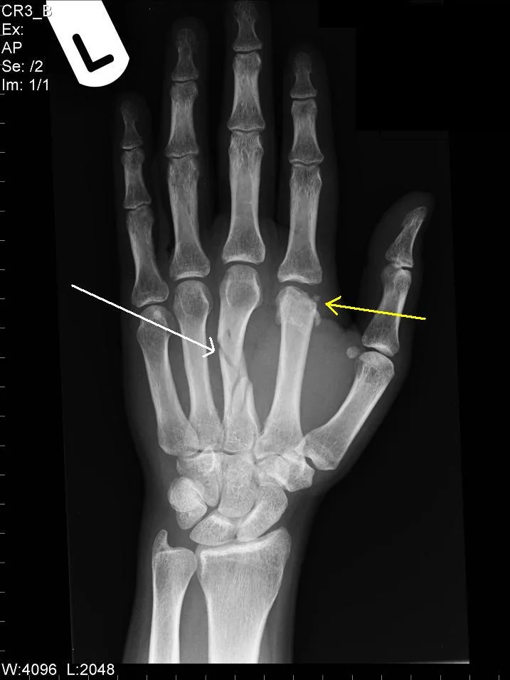 Magnetoterapia para fractura de metacarpianos