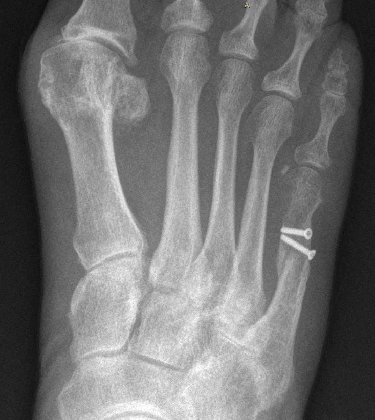 Magnetoterapia para fractura de metatarsianos