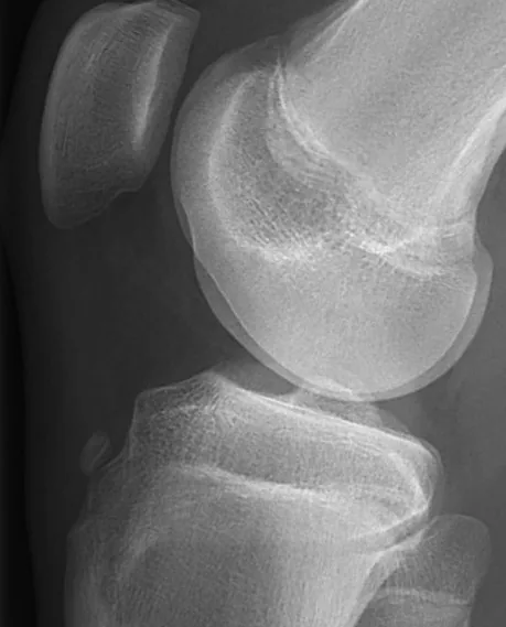 Magnetoterapia para fractura por avulsión