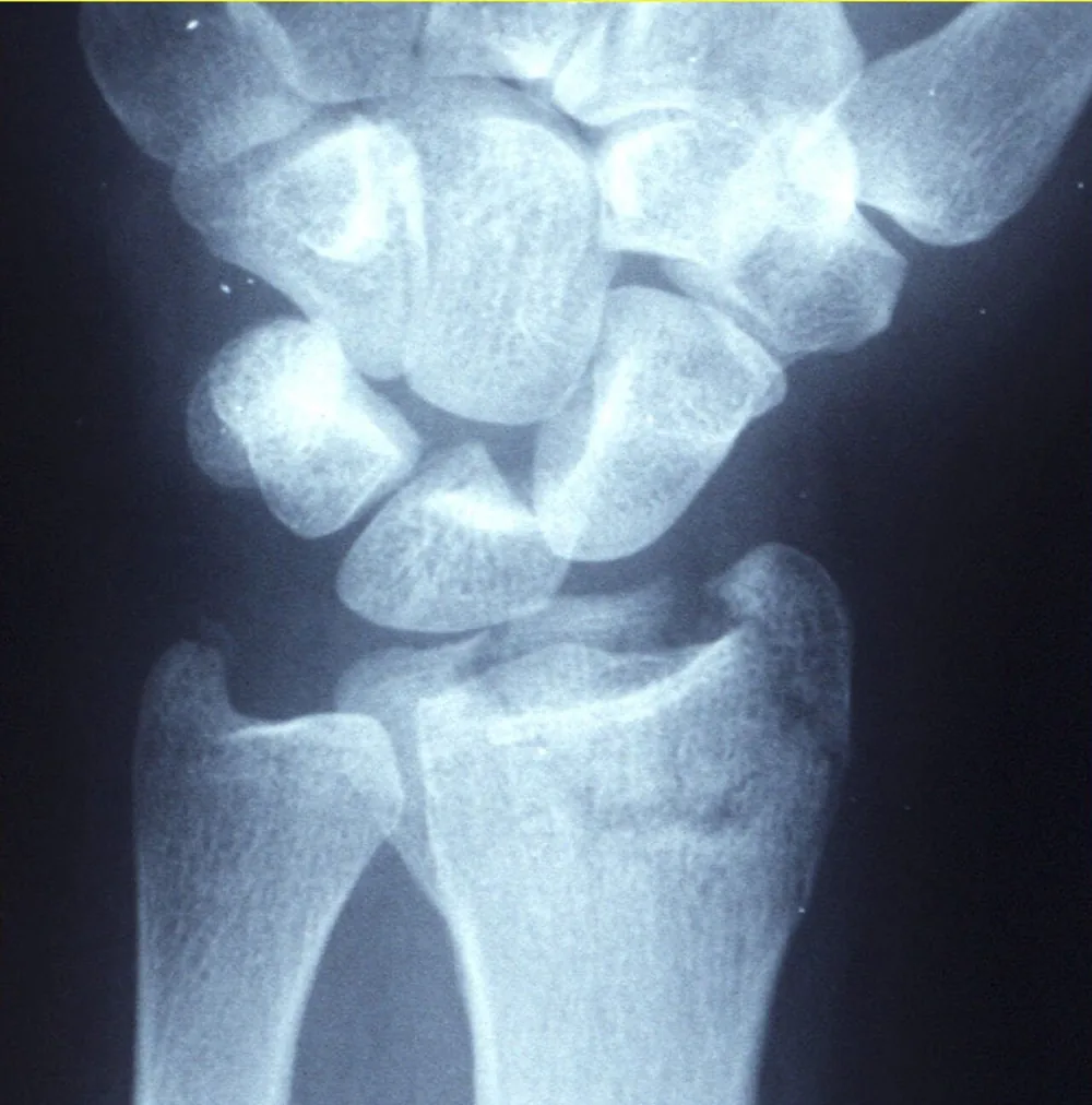 Magnetoterapia para fractura de radio (Colles)