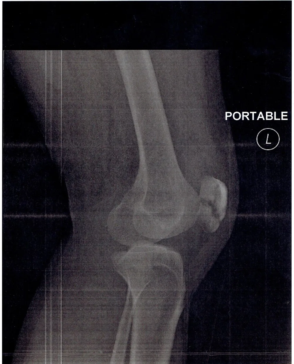 Magnetoterapia para fractura de rótula