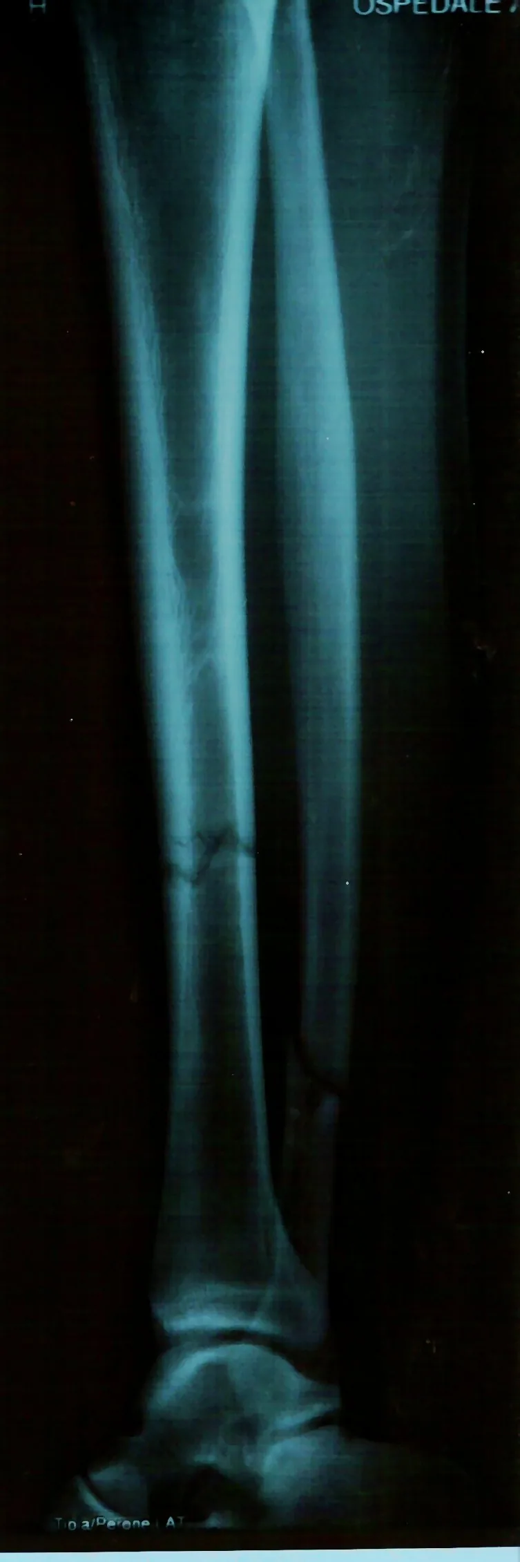 Magnetoterapia para fractura de tibia y peroné