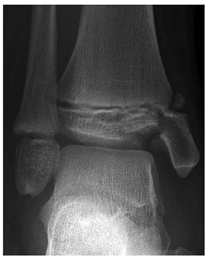 Radiografía de una fractura de tobillo con afectación del maléolo