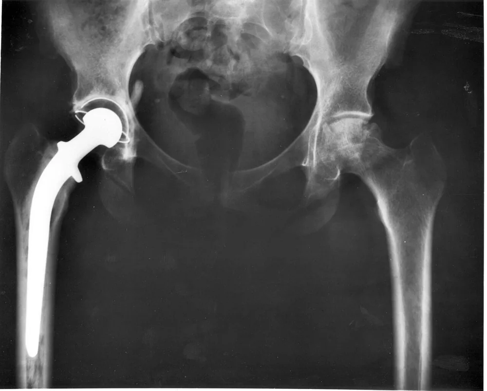 Magnetoterapia tras prótesis de cadera