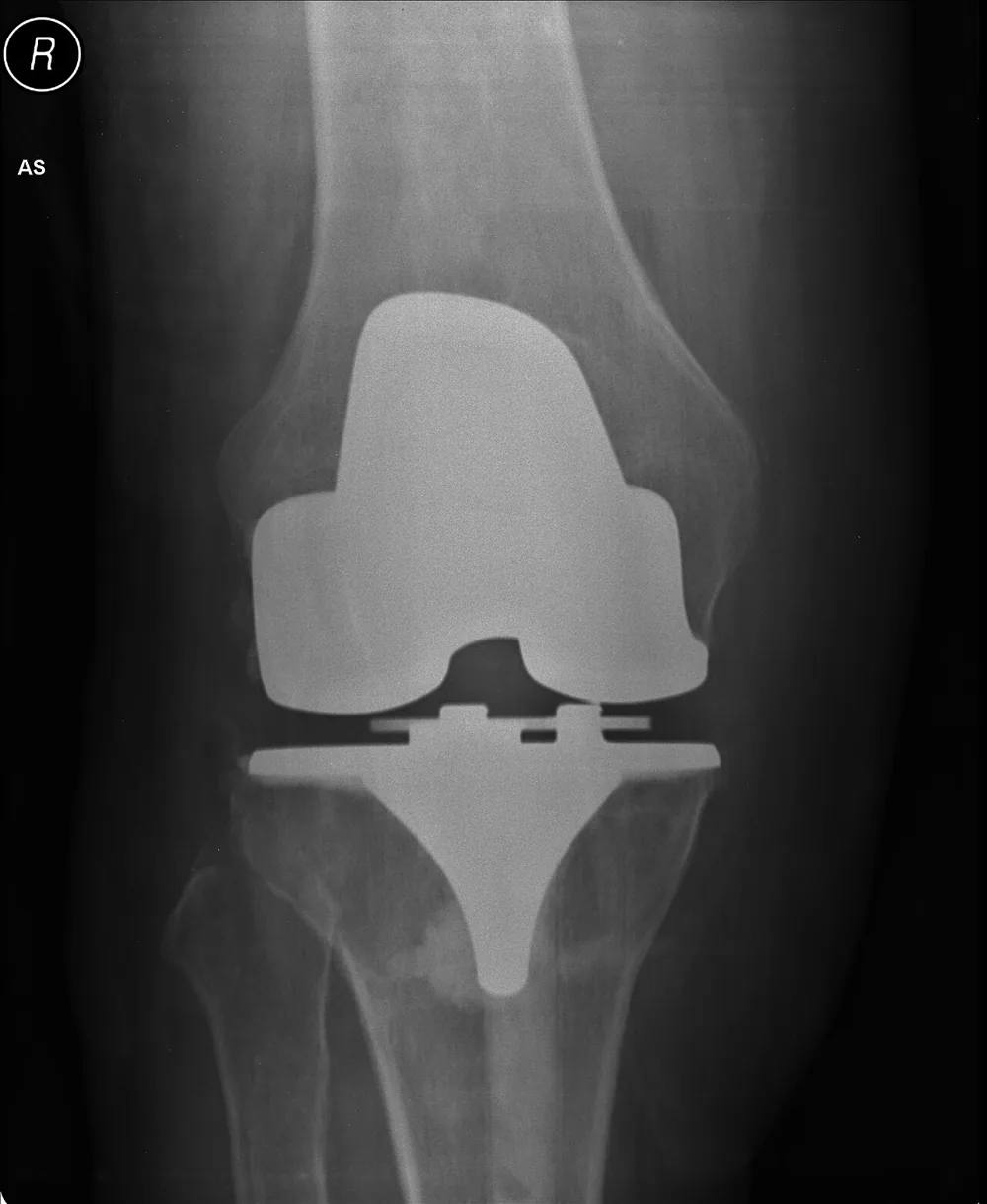 Magnetoterapia tras prótesis de rodilla