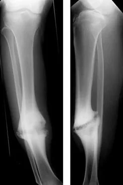 Magnetoterapia para la pseudoartrosis