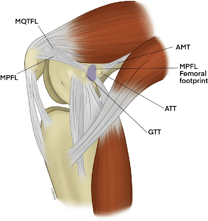 Magnetoterapia para la tendinopatía del cuádriceps